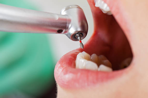 Best Emergency Root Canal Treatment in Burbank, WA